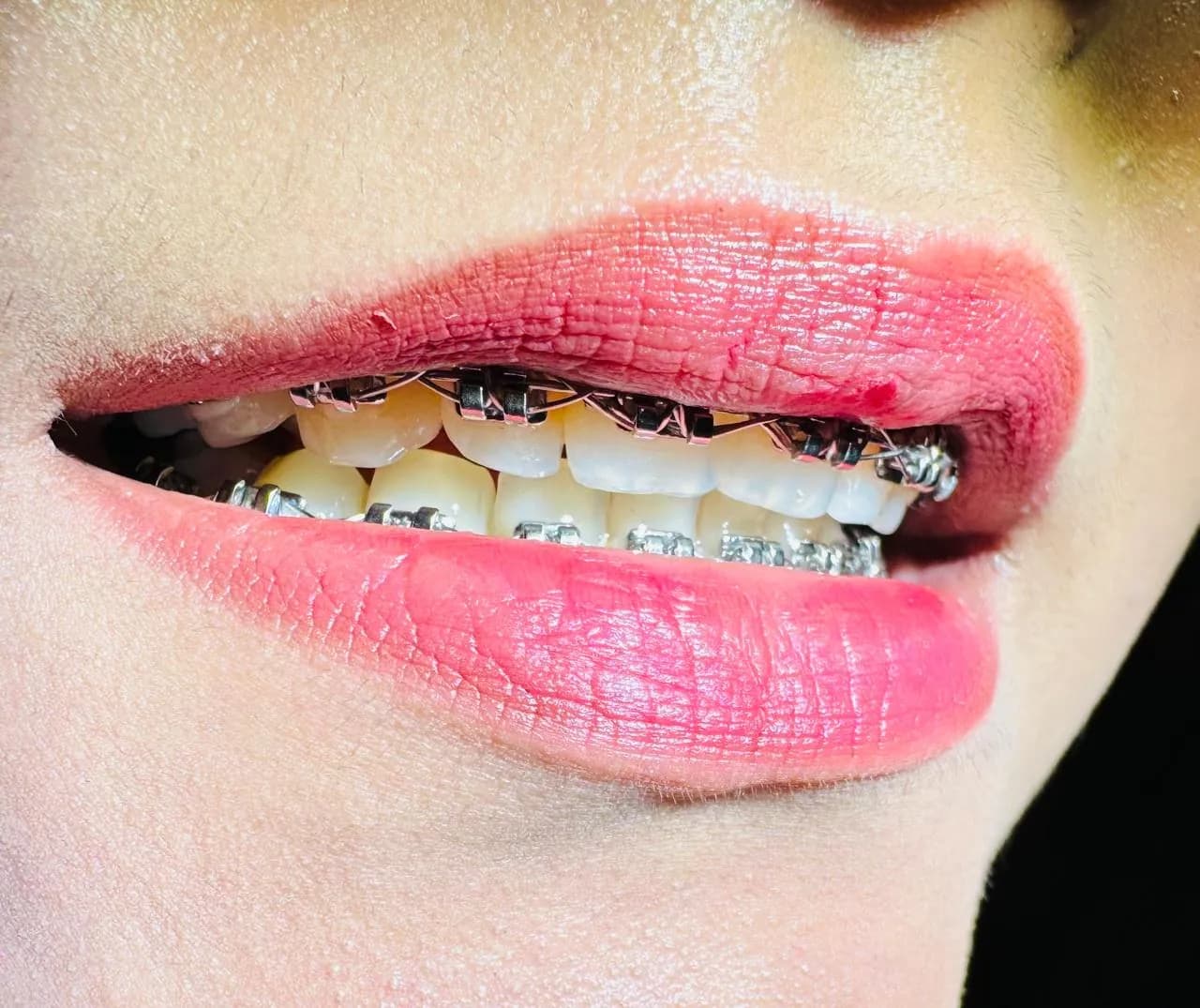 A patient with modern dental braces during a check-up